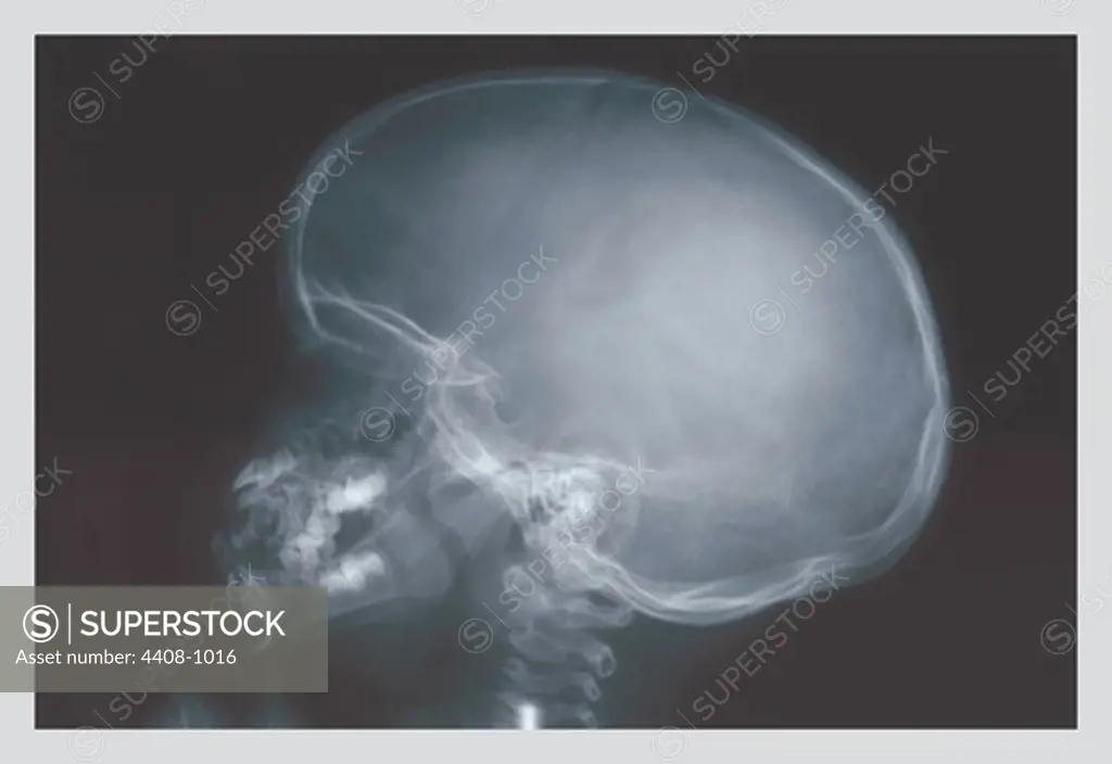 Skull, Medical - Xray / Radiology