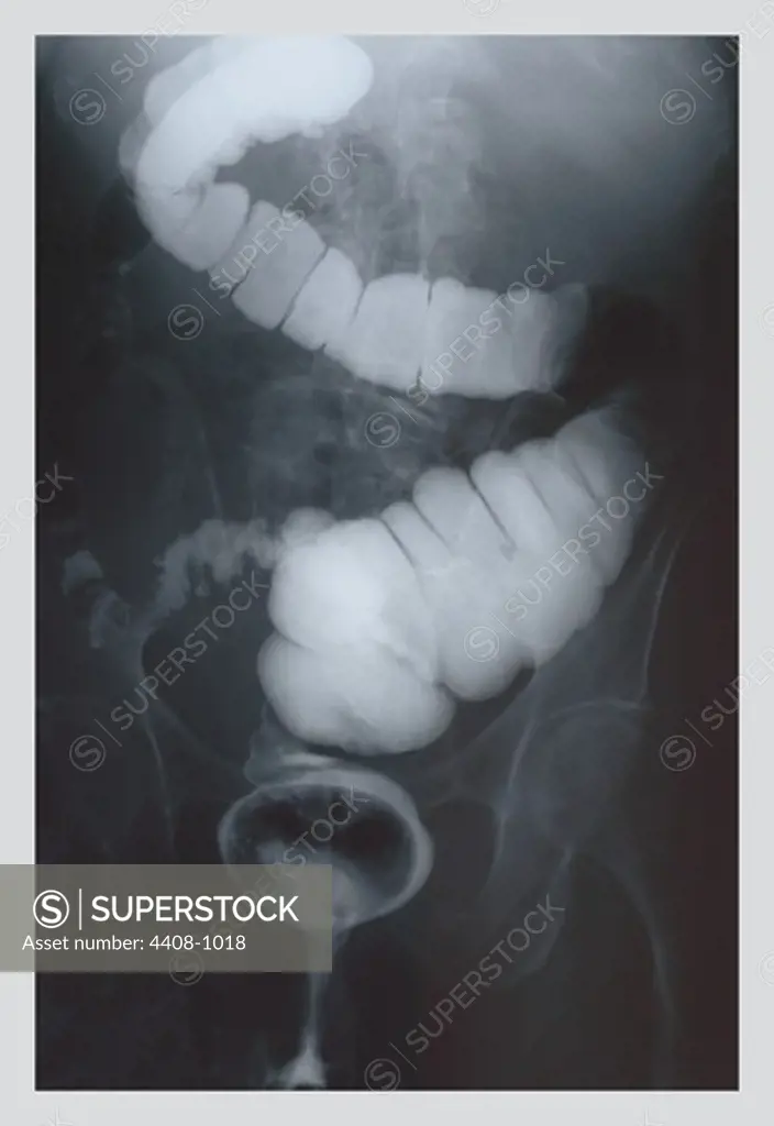 Intestine Barium, Medical - Xray / Radiology