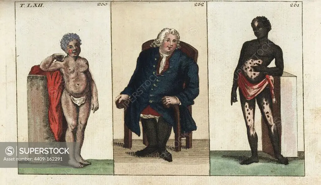 An albino African woman, the corpulent Edward Bright of Maldon, Essex, and a South African man with vitiligo. Handcolored copperplate engraving from G. T. Wilhelm's "Encyclopedia of Natural History: Mankind," Augsburg, 1804. Gottlieb Tobias Wilhelm (1758-1811) was a Bavarian clergyman and naturalist known as the German Buffon.