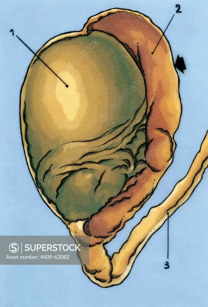 Human male reproductive system. Testis without the scrotal sac. 1. Testicle 2. Epididymis 3. Vas deferens. Drawing. Colour.