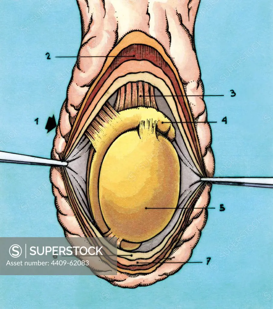Human male reproductive system. Scrotal sac opened. 1. Scrotum 2. Cremaster muscle 3. Spermatic cord 4. Epididymis 5. Testis 6. Tunica vaginalis 7. Common vaginal tunic. Drawing. Colour.