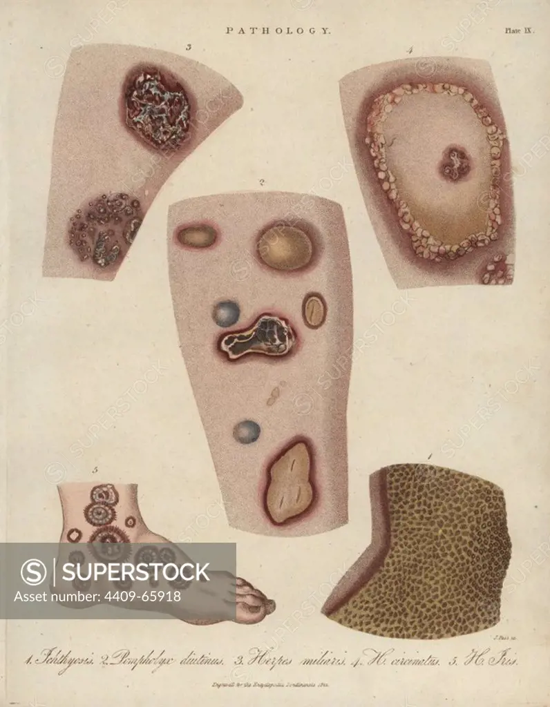 Ichthyosis, Dyshidrosis, and Herpes skin diseases. Handcoloured copperplate stipple engraving by John Pass from John Wilkes' "Encyclopedia Londinensis," J. Adlard, London, 1822.