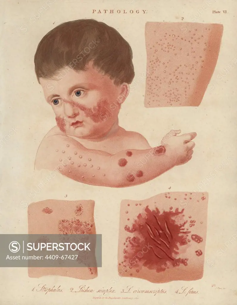 Red gum or Strophulus, a skin disease affecting infants, and Lichen simplex, a thickening of the skin after pruritus. Handcoloured copperplate stipple engraving by John Pass from John Wilkes' "Encyclopedia Londinensis," J. Adlard, London, 1822.