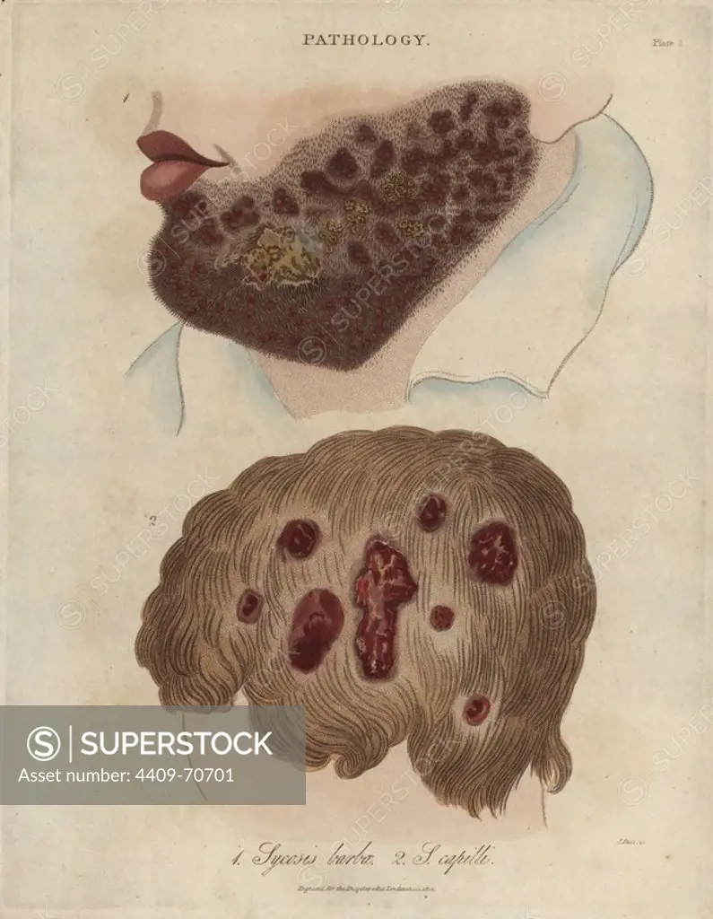 Sycosis barbae and Sycosis capilli, chronic inflammation of the hair follicles, especially of the beard and head. Handcoloured copperplate stipple engraving by John Pass from John Wilkes' "Encyclopedia Londinensis," J. Adlard, London, 1822.