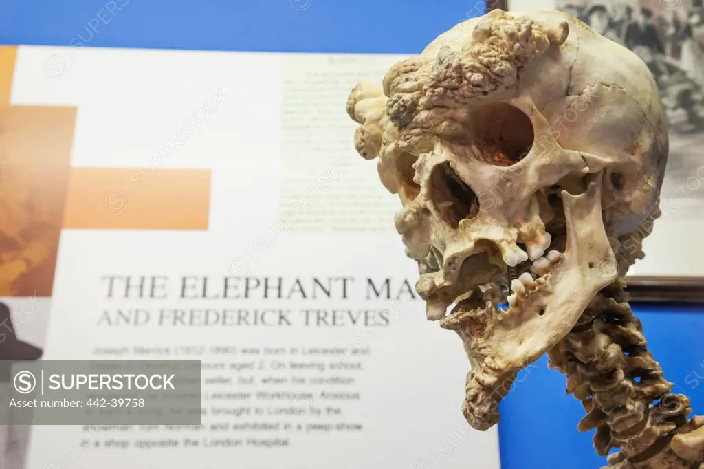 UK, England, London, Whitechapel, Royal London Hospital Museum, Reproduction Skeleton of Joseph Merrick aka Elephant Man