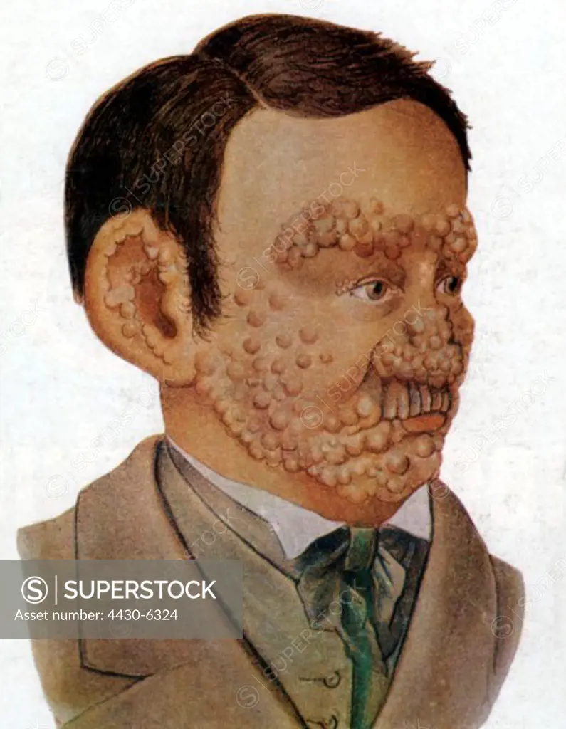 medicine sickness Leprosy portrait of a man with tuberculoid leprosy lithograph after Boeck and Danielsen 1848,