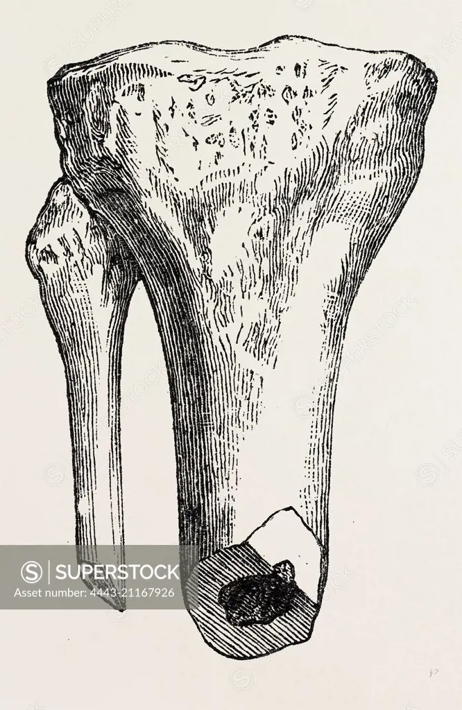 method of  method of sawing, medical equipment, surgical instrument, history of medicine