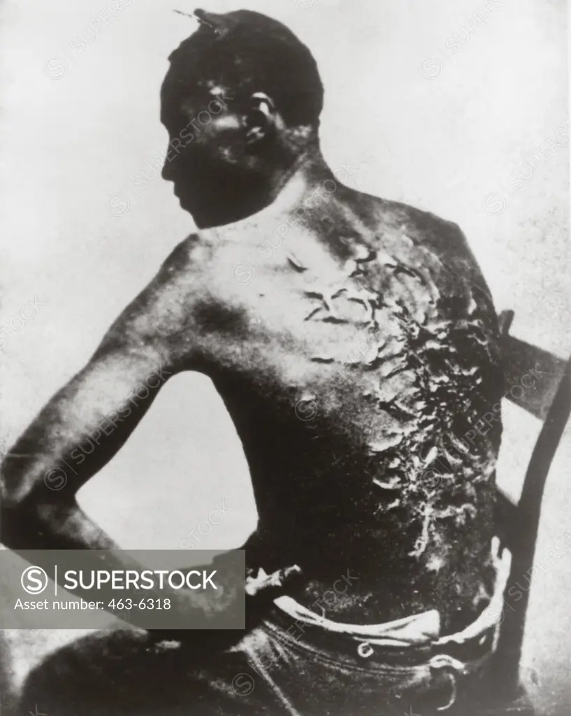 Scars on the back of an escaped slave, 1863