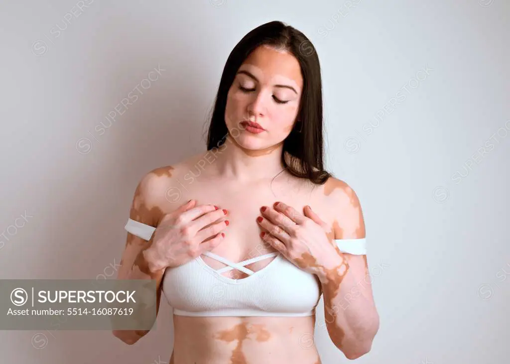 portrait of a young woman, a real vitiligo patient, posing in th