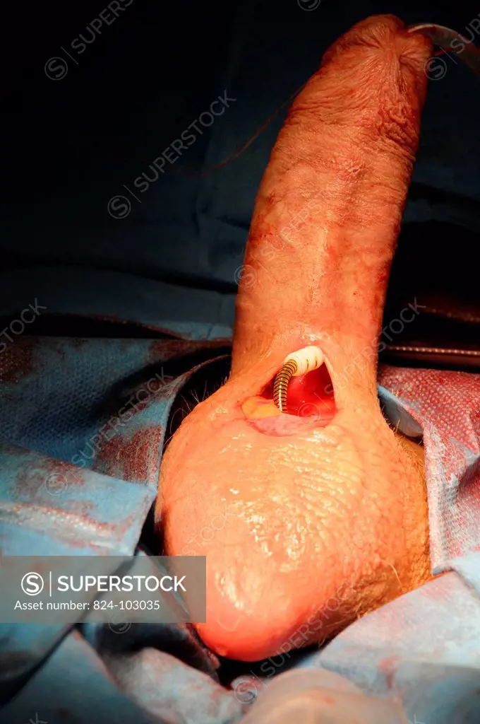 Photo essay at Lyon hospital. Department of urology. Surgical treatment of erectile dysfunction with a penile prosthesis. Test of erection with prosth...