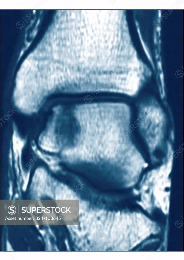 This frontal MRI image of the right ankle reveals an osteochondritis of the astragalus.