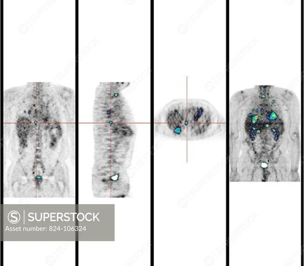 RECTAL CARCINOMA. RECTAL CARCINOMA Institute of Nuclear Medicine, University Hospital of Lille, France.   PET Scan (Positron emission tomography).  Colorectal carcinoma. Several liver and lung abnormalities which contra-indicate surgical intervention.