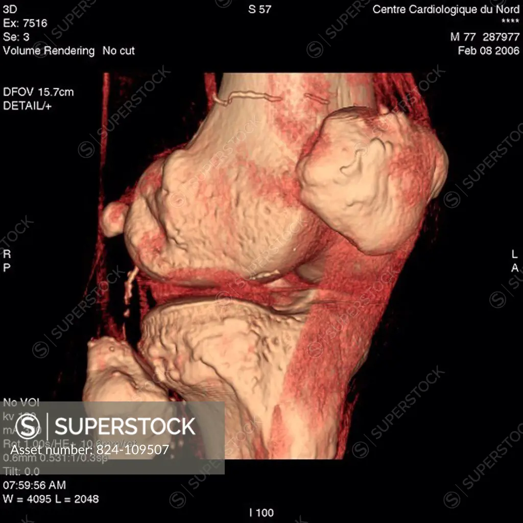 <BR> <BR>Gonarthrosis checkup. 3D scanner. Intermediary thresholding for the visualization of the bone, the  tendons and the articular cavity.  This i...