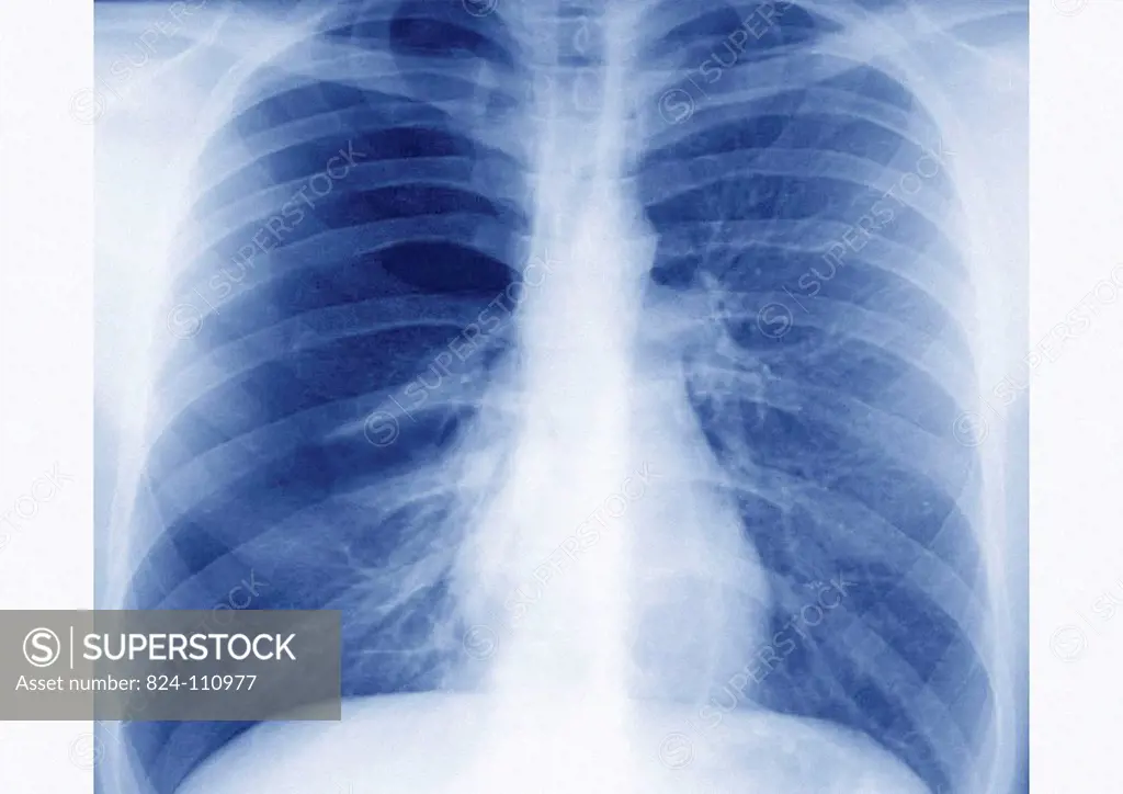 Pulmonary x_ray undertaken during an allergic asthma crisis.