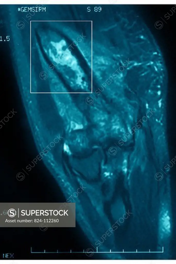 MYELOMA, MRI. MYELOMA, MRI Femur, frontal view.