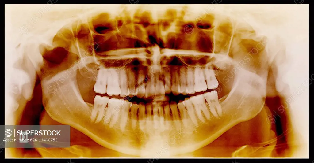 Healthy dental panoramic x-ray in a 29-year old woman.