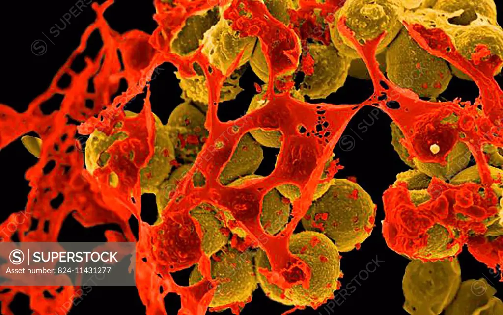Scanning electron micrograph of methicillin-resistant Staphylococcus aureus (MRSA, brown) surrounded by cellular debris. MRSA resists treatment with m...