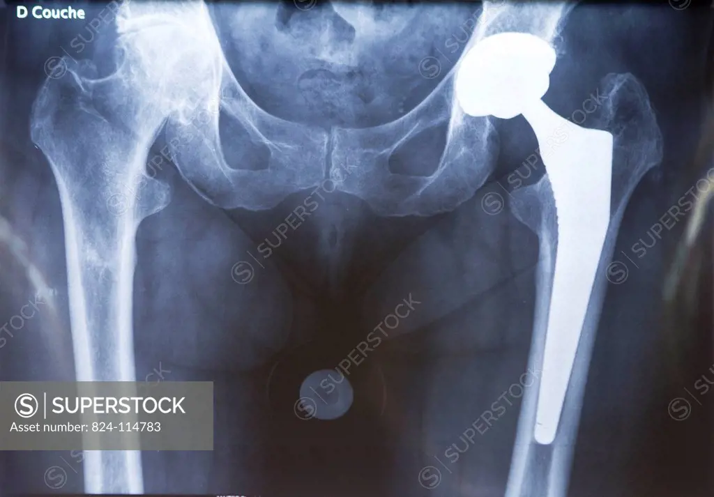 Reportage in the orthopaedic surgery unit in the Diaconesses Croix Saint Simon hospital in Paris. Placing a second hip prosthesis. X_ray of the patien...
