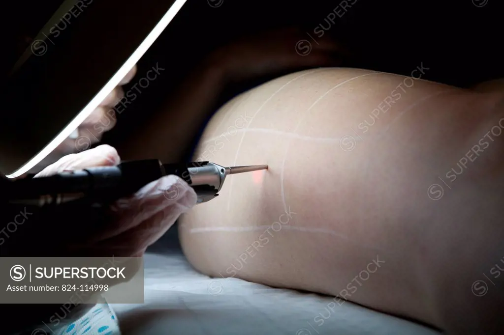 Esthetic medecine in Dr Gaucher´s practice in Paris. Laser hair removal session using an Alexandrite laser.