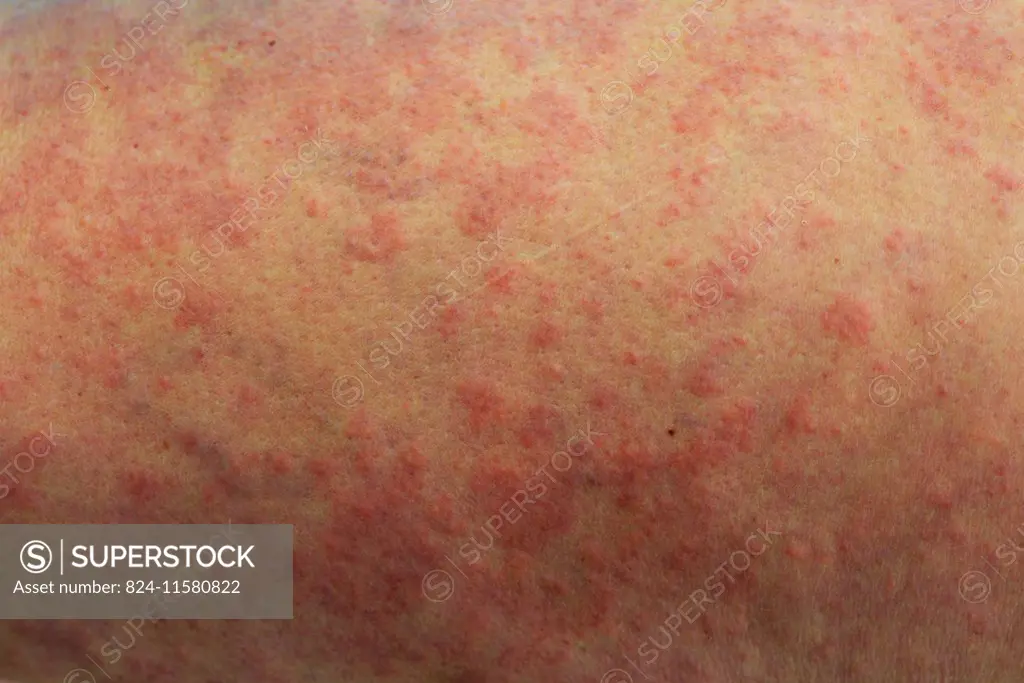 erythema. an erythema is a skin lesion characterised by a congestive skin rash.