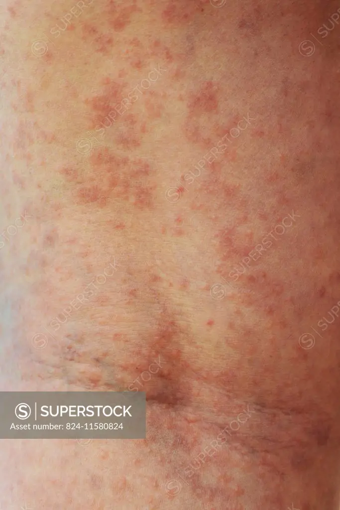 erythema. an erythema is a skin lesion characterised by a congestive skin rash.