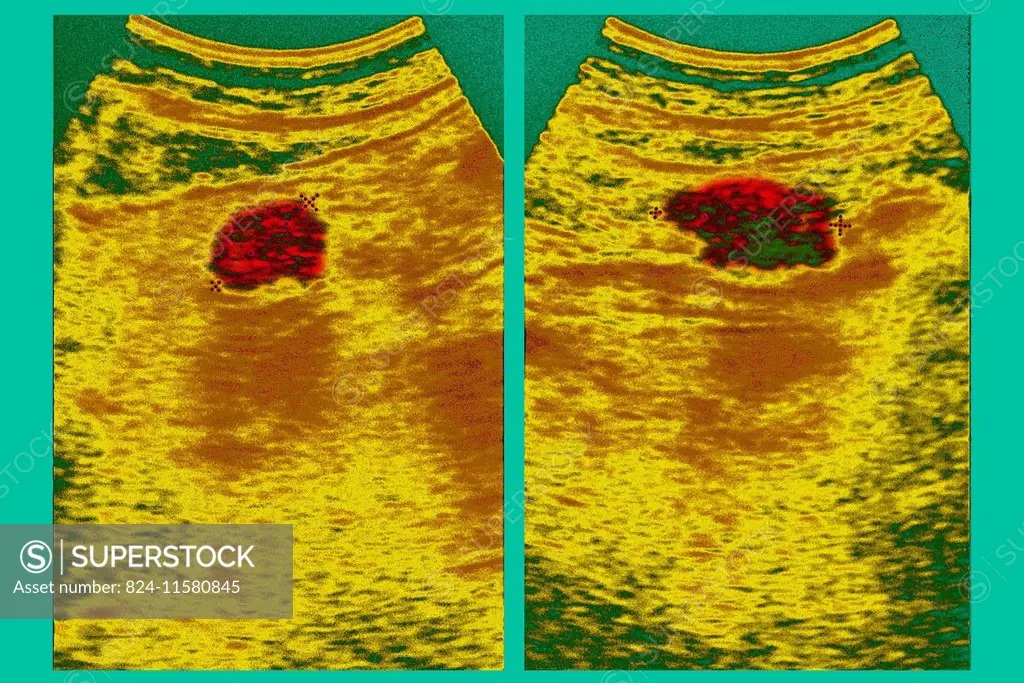 scan showing a peptic ulcer.