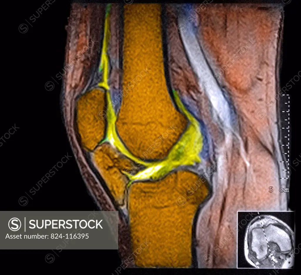Coloured Colour Magnetic Resonance Imaging MRI scan of a side view of the knee joint of an adult man.