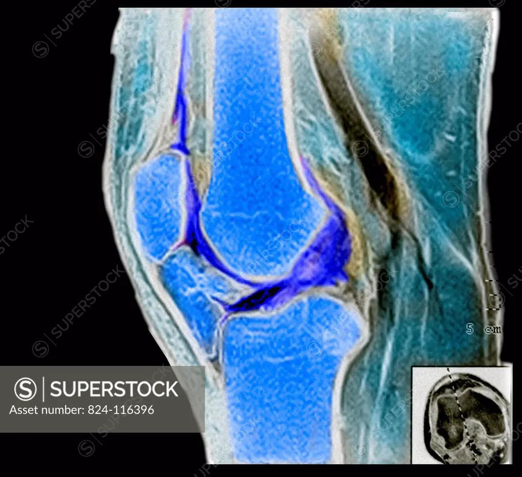 Coloured Colour Magnetic Resonance Imaging MRI scan of a side view of the knee joint of an adult man.