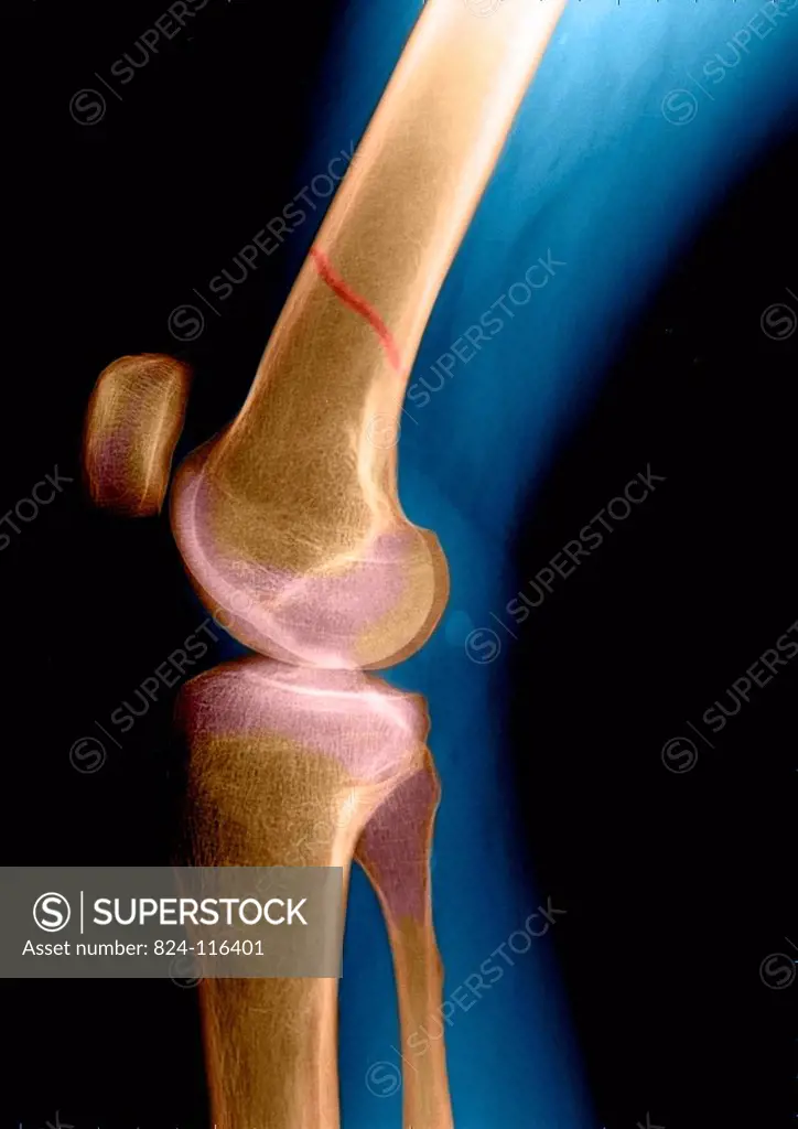 X ray of the fractured leg of a 78 years old patient.
