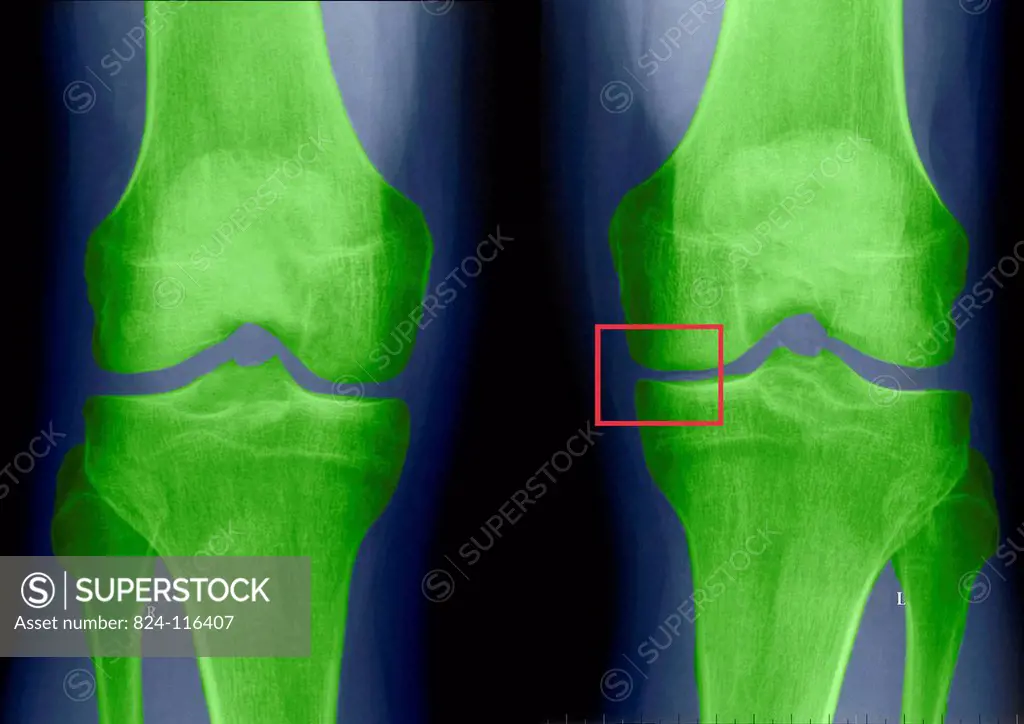 Notable pinching of the left joint following arthroscopy. X_ray.