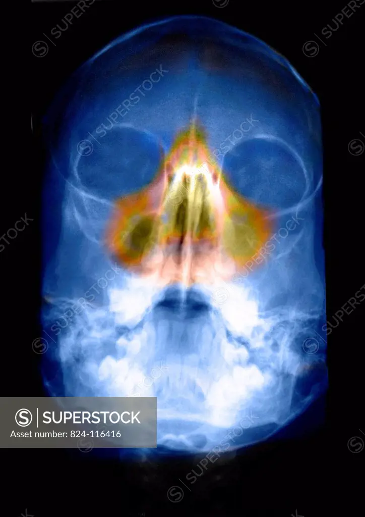 Skull x_ray of a little girl. Normal.