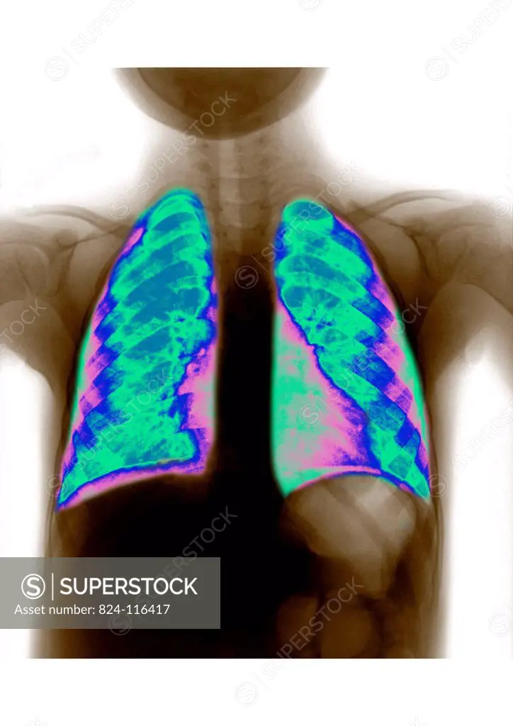 Normal lung x_ray of a little girl.