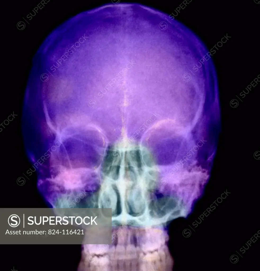 X_ray of the sinuses of a 35_year old woman. Bilateral hypertrophy of both left and right middle and inferior nasal concha.