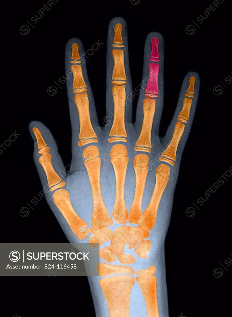 Coloured X ray of the right hand and fourth finger of a ten years old boy. No fracture or contusion visible.
