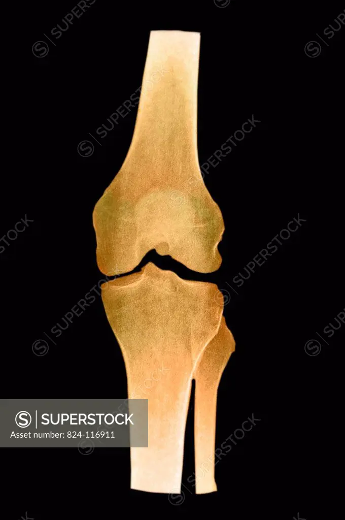 X_ray of a 40_year old woman´s knee. No anomaly.