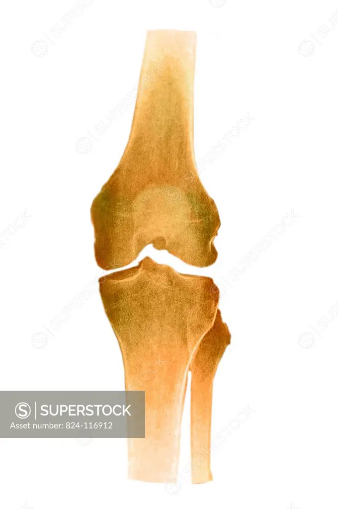 X_ray of a 40_year old woman´s knee. No anomaly.