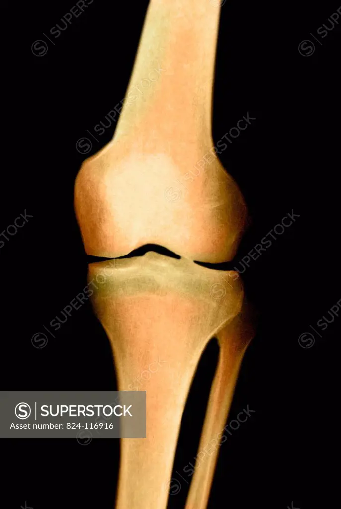 X_ray of a 30_year old man´s left knee. No anomaly.