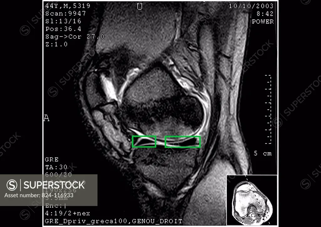 MRI scan of the left knee showing the largely damaged internal miniscus. The patient will have to undergo arthroscopy.