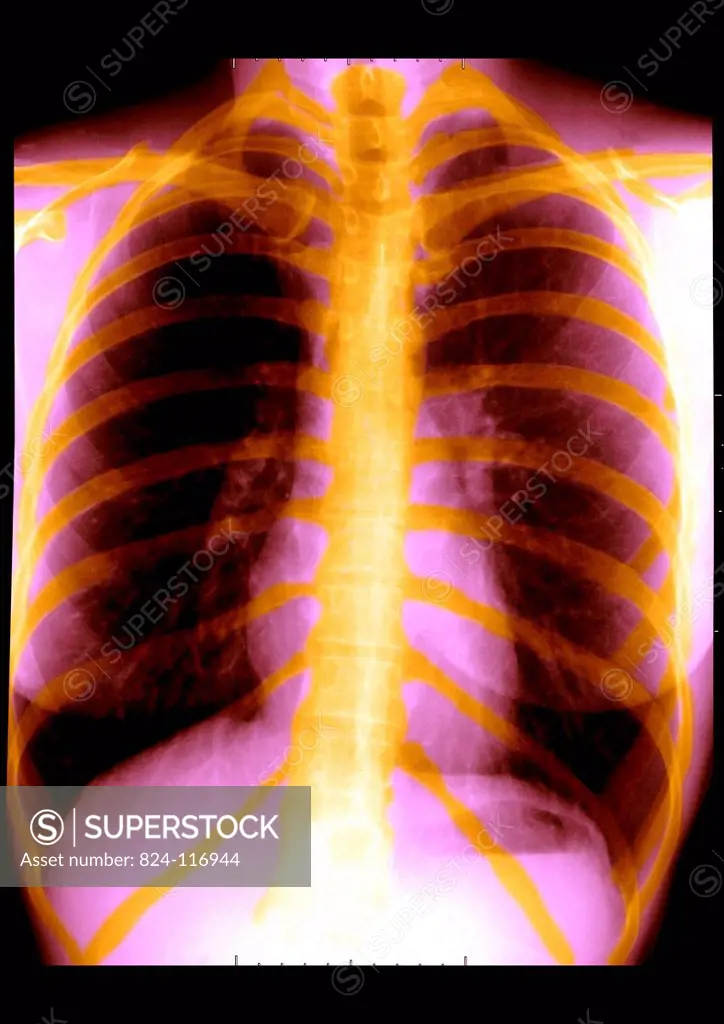 Normal lung x_ray of a 26_year old patient.