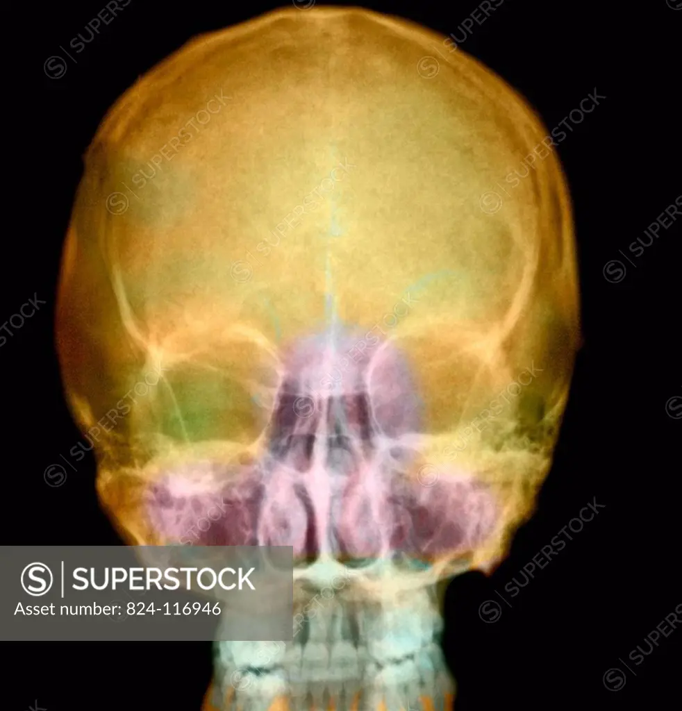 X_ray of the sinuses of a 35_year old woman. Bilateral hypertrophy of both left and right middle and inferior nasal concha.