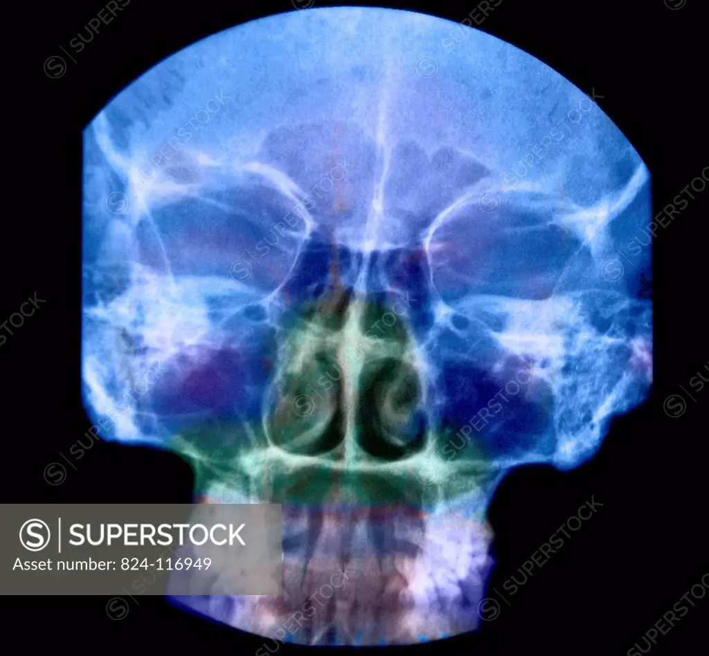 X_ray of the sinuses of a 35_year old woman. No anomaly observed.