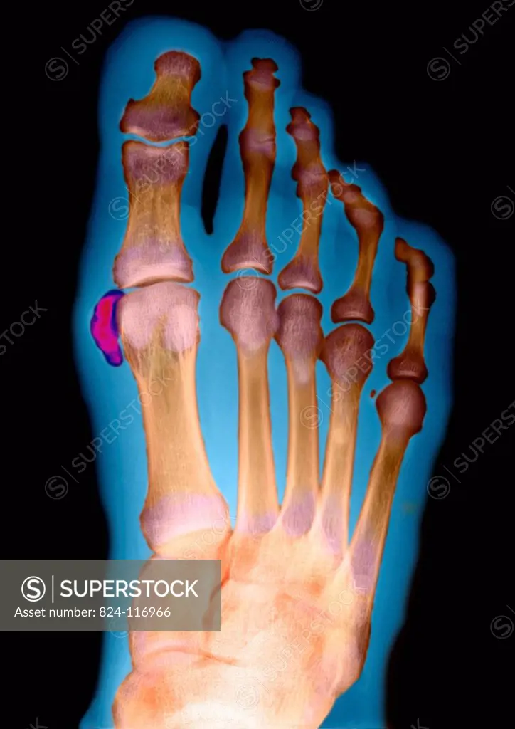 Bone calcification of the big toe on a 29 years old foot patient. X ray