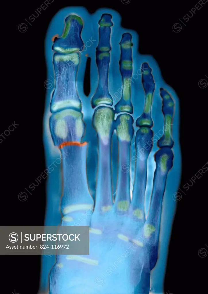 X ray of the left foot of a 29 years old male patient. Fracture of the first metatarsal bone.