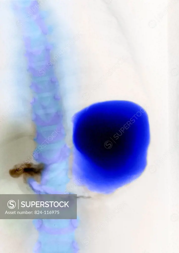 X_ray of a young child´s stomach. No anomaly of the digestive system.