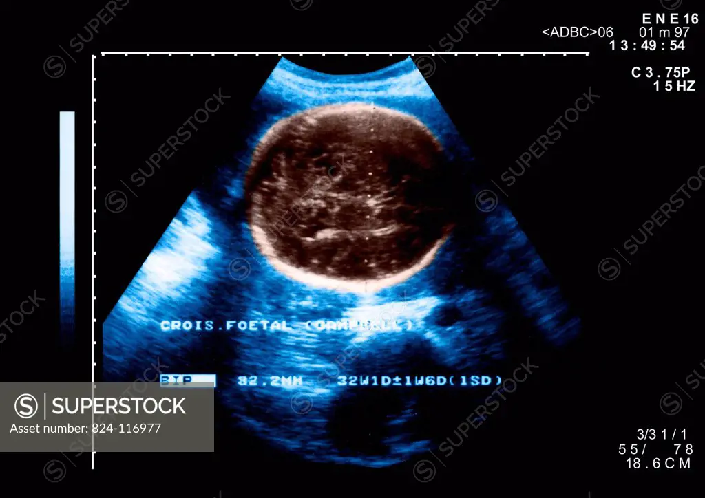 Ultrasound scan of a woman who is 8 months pregnant. Biparietal diameter of the skull.