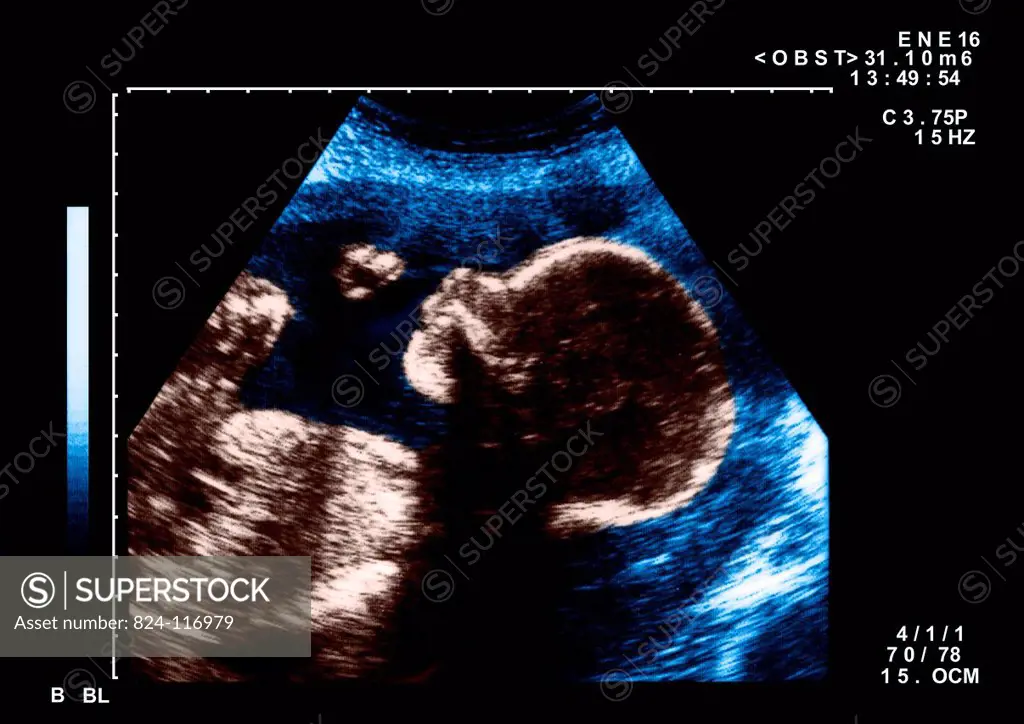 Ultrasound scan of a woman who is 4 months pregnant.