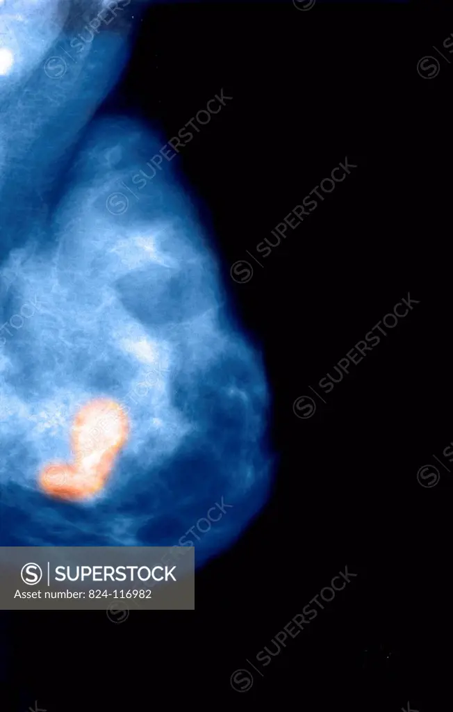 Mammogram of a 35_year old patient´s left breast. Slight tangible densification deep down nodule. The patient will have to undergo a cytological punct...