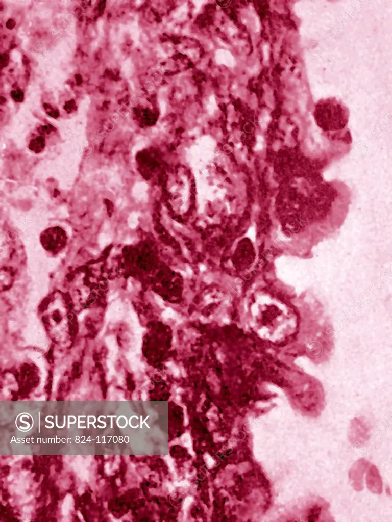Cervical cancer. Cellular anomalies seen by the microscopy of a histological section of the endocervical epithelium.