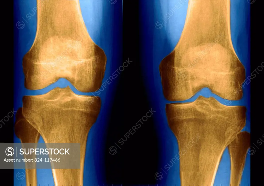 X_ray after arthroscopy on the left knee. The joint can be seen to be slightly pinched.