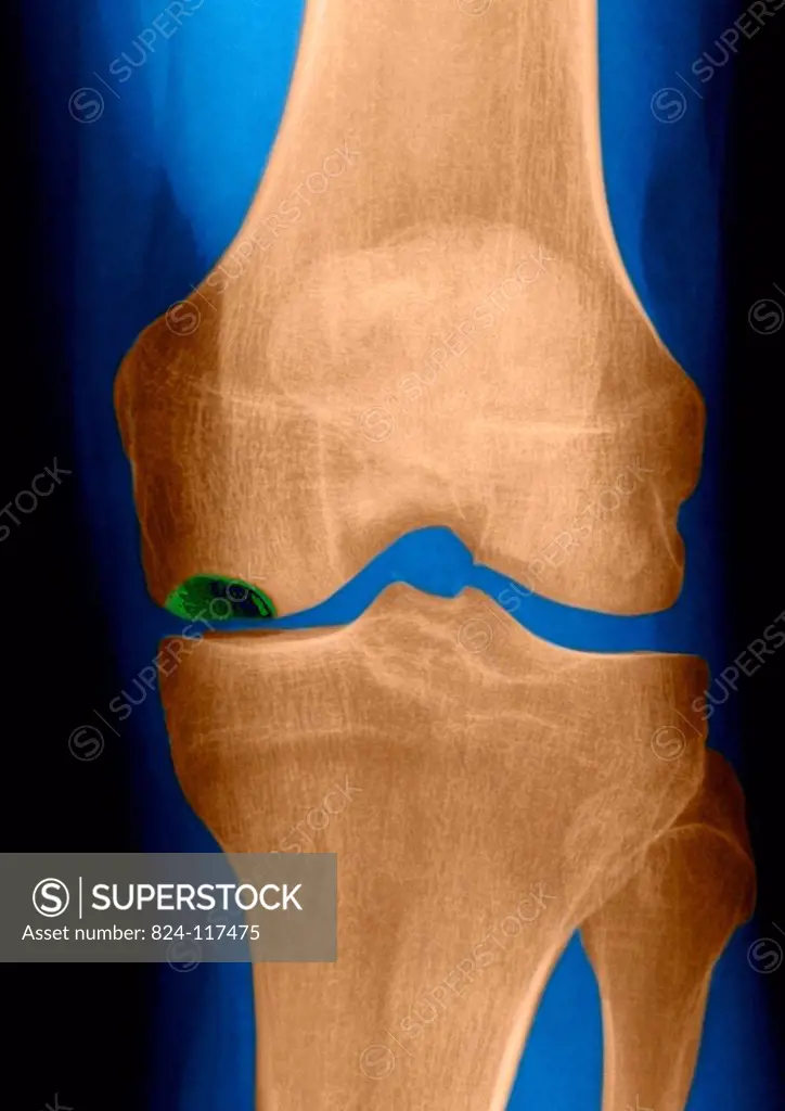 Severe osteonecrosis of the knee of a 78 years old patient. X Ray